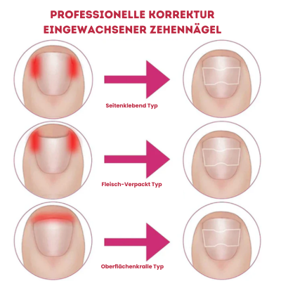 NailFix - Pflegeaufkleber für Nagelkorrekturen