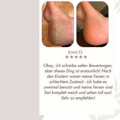 CallusCare™ - Elektrische Fußfeile | 50% RABATT