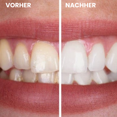DazzleWhite™ | Zahnweißungsgel - Jetzt 1+1 Gratis!