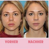 ContourV- Gesichtsabsaugtrainer